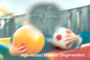 Age-related Macular Degeneration (AMD), NEI